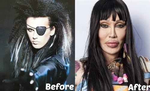 pete-burns-plastic-surgery