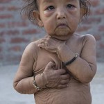 benjamin-button-cocuklar-benjamin-button-hindistan-hastalik-1537247