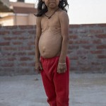 benjamin-button-cocuklar-benjamin-button-hindistan-hastalik-1537251