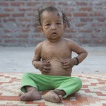 benjamin-button-cocuklar-benjamin-button-hindistan-hastalik-1537252