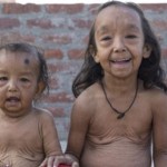 benjamin-button-cocuklar-benjamin-button-hindistan-hastalik-1537254