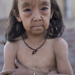 benjamin-button-cocuklar-benjamin-button-hindistan-hastalik-1537255