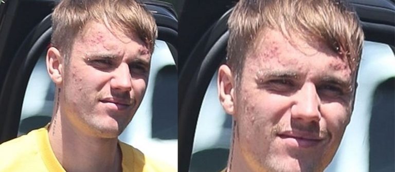 Justin Bieber’ın yüzünü sivilce bastı